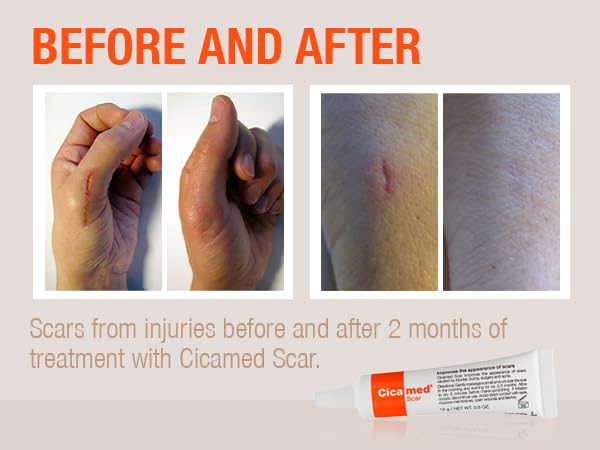 Silicone Scar Gel - Works with Tape - Advanced Cream for Surgical Scars, C-Section, Burns, Keloids, and Acne Marks - 0.5 oz (15g)