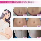 1 PCS Stretch Marks and Scar Cream, Stretch Mark and Scar Removal Cream for Pregnancy, Belly Creams for Wrinkles, Obesity Fat Marks Scars Moisturizing, Remove Marks