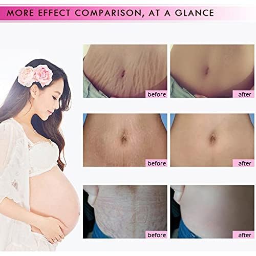 1 PCS Stretch Marks and Scar Cream, Stretch Mark and Scar Removal Cream for Pregnancy, Belly Creams for Wrinkles, Obesity Fat Marks Scars Moisturizing, Remove Marks