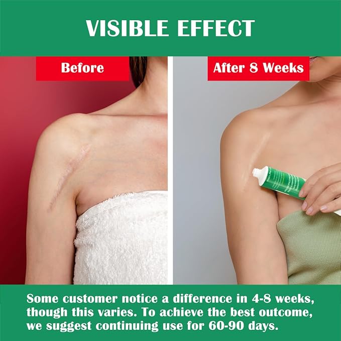 Advance Silicone Scar Cream Gel: Old & New Scars Treatment Stretch Marks Removal - Body Face Surgical Skin Healing - Recovery C-Section Keloids Injury Acne Wound Dark Spot for Kids 1oz (30 g) (Green)