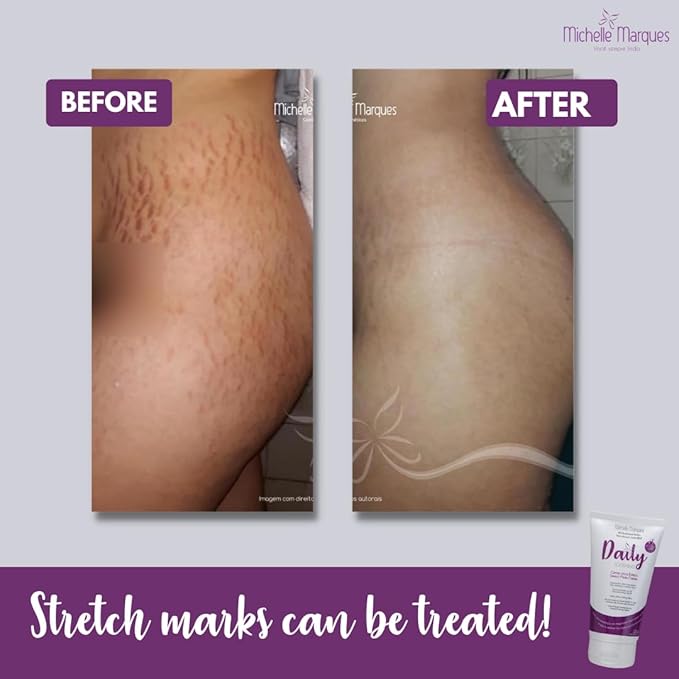 Stretch Mark Cream, Soften and Reduce the Appearance, Provides Hydration, and Improves Skin Elasticity and Texture, 5.29oz