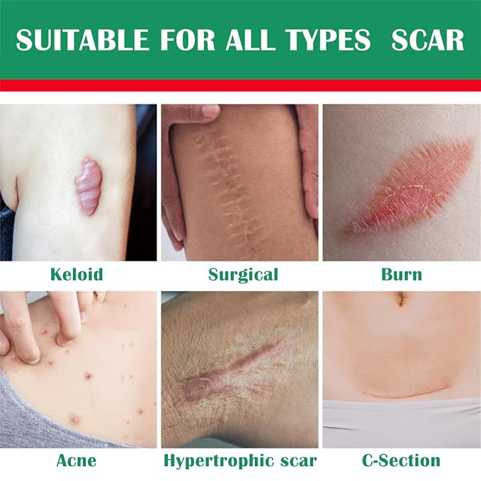 Advance Silicone Scar Cream Gel: Old & New Scars Treatment Stretch Marks Removal - Body Face Surgical Skin Healing - Recovery C-Section Keloids Injury Acne Wound Dark Spot for Kids 1oz (30 g) (Green)