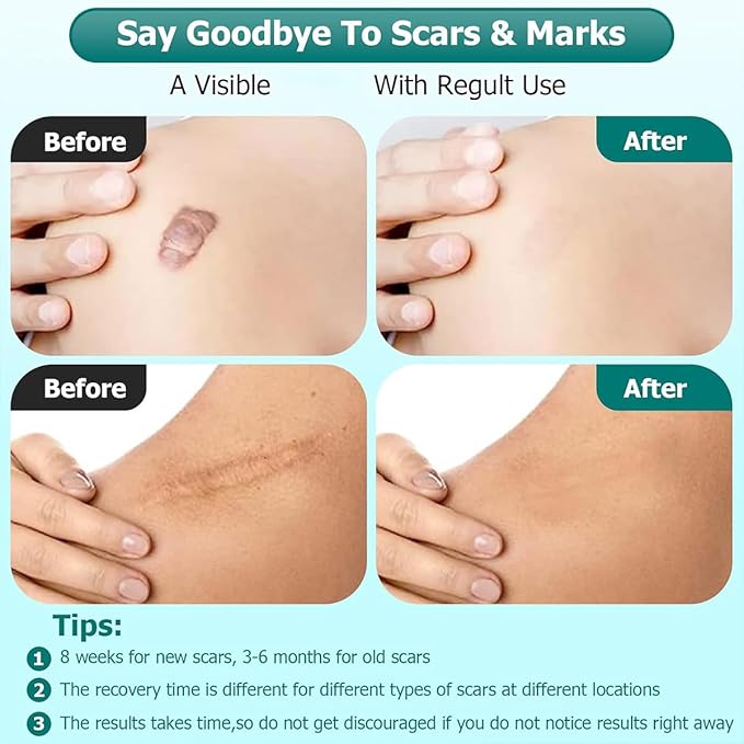 Advanced Scar Gel for Surgical Scars, Face, Body, Legs, Burns, Acne, C-Section, Stretch Marks, Keloids - Effective Scar Removal for Men and Women, Suitable for Old & New Scars (100% New -2 Bottle)