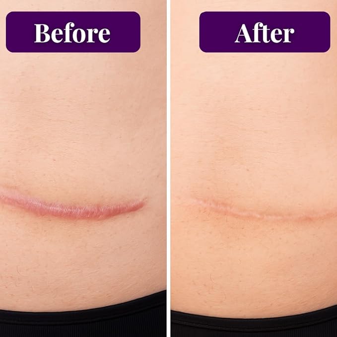 Nurse Harvey's Straderma 40gr/1.41 fl oz (Advanced Scar Gel, Wound and Spot Gel, Burn & Sun Scar Gel, Scar Removal Gel for C-Section, Stretch Marks, Acne, Surgery, Old and New Scars)