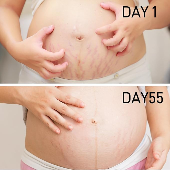 Stretch Mark Cream for Pregnancy - Deep Repair & Prevention for Stretch Marks - Stretch Mark Oil/Lotion for Women - Prenatal & Postnatal Skin Care (1_Pack)