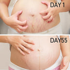 PEGO Stretch Mark Oil for Pregnancy, Maternity Body Oil for Stretch Mark Prevention & Reduction, Hydrating Skin Care, 5.41oz (Oil+Cream)