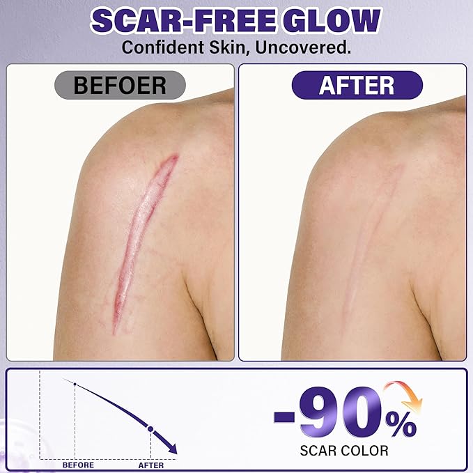 Silicone Scar Gel, Advanced Scar Cream for Burns & Acne Scars away, Stretch Marks, Surgical, Old & New, Surgery Scaraway Treatment, 1.7 oz (50ml)