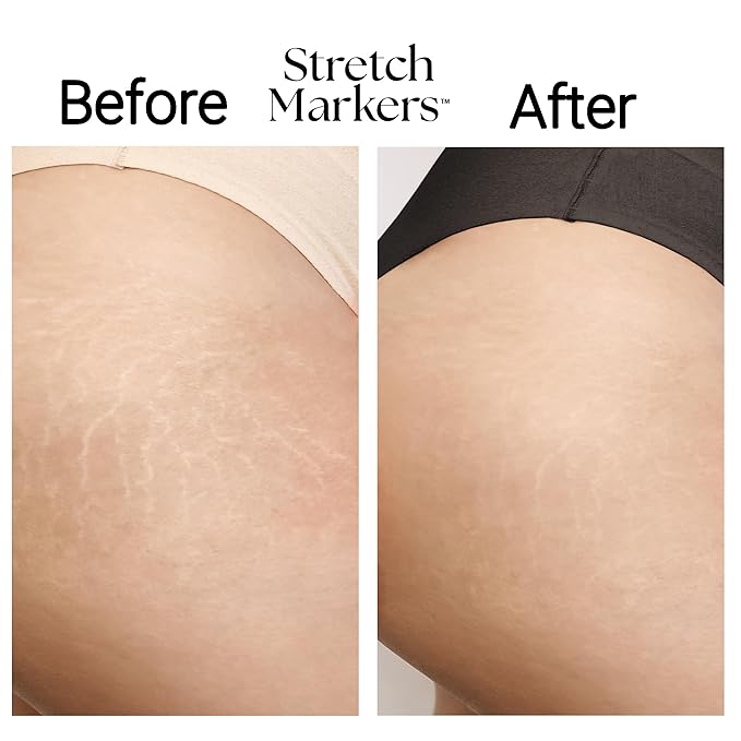 StretchMarkers Pregnancy Defender – Stretch Mark Cream for Pregnancy, Visibly Reduces & Treats with Bakuchiol, Hyaluronic Acid, Bioactive Peptides & 3D Stem Cell Technology, Retinol-Free, 1 fl oz