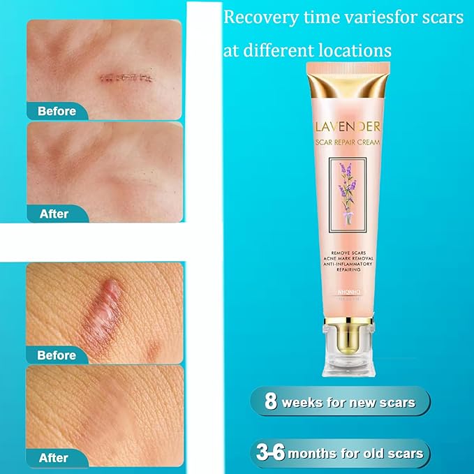 Lavender Scar Repair Cream for surgical scars, burns, acne, C-sections, stretch marks, keloids, and scar removal. Suitable for men and women. 1.7 oz. (1)