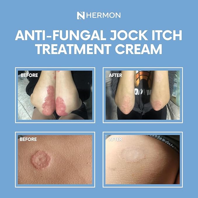 Hermon Jock Itch Antifungal Cream, Ringworm Treatment for Humans, Psoriasis Scalp Treatment, Ringworm Cream for Humans, Foot & Body Balm, Provides Soothing Relief-2 Pack
