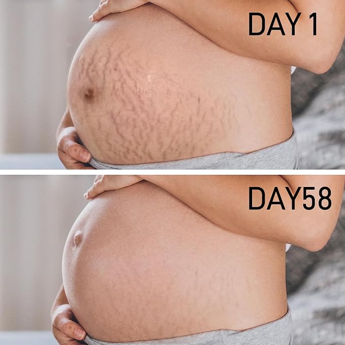 PEGO Stretch Mark Oil for Pregnancy, Maternity Body Oil for Stretch Mark Prevention & Reduction, Hydrating Skin Care, 5.41oz (Oil+Cream)