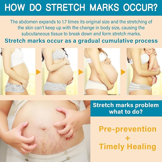 Stretch Mark Cream for Pregnancy - Deep Repair & Prevention for Stretch Marks - Stretch Mark Oil/Lotion for Women - Prenatal & Postnatal Skin Care (1_Pack)
