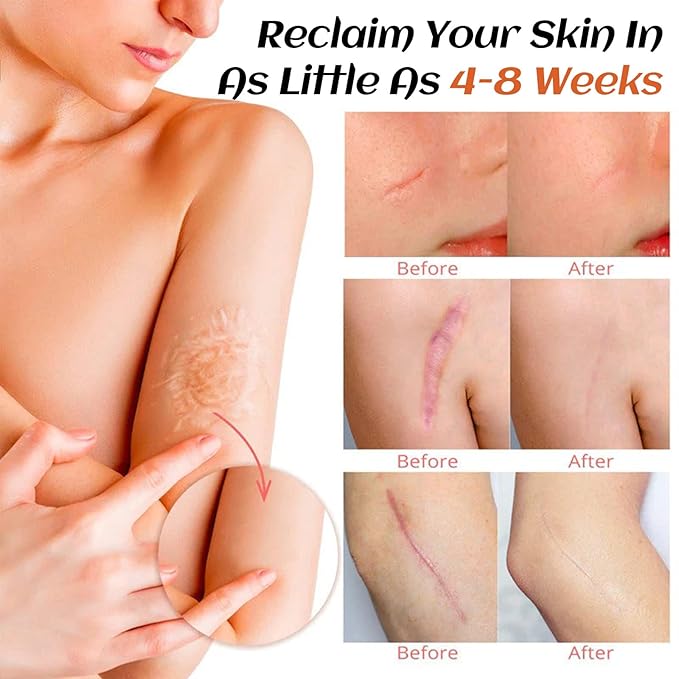 Silicone Scar Cream,Silicone Gel for Scars,Professional Scar Removal Cream for Surgical and Old Scars,Stretch Marks, Old and New Scars