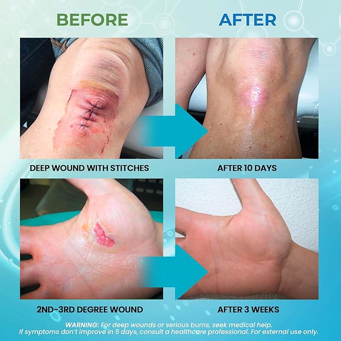 MediQuick Antiseptic Spray Mist 4 Fl Oz | Skin & Wound Repair First Aid Spray for Burns & Cuts with 12 Hour Action | Helps Heal Acne Rash Eczema Itch Bites & More | Safe Wound Wash with No Sting