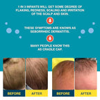 Happy Cappy Medicated Shampoo and Body Wash and Beanie Brush Bundle - Baby Dandruff Shampoo, Helps Cradle Cap and Seborrheic Dermatitis, Fragrance-Free, Gentle Baby Scalp Scrubber - 2 Pieces