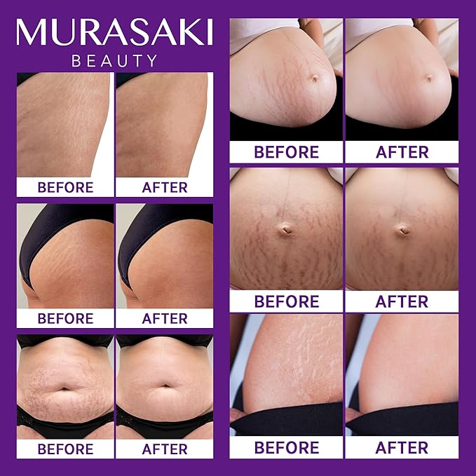 Stretch Mark Cream Prevention for Pregnancy - Maternity Cream for Stretch Marks Removal | Nourishing Formula – Prevents Stretch Marks & Improves Elasticity - 4 oz (120g) (4 oz (120g))