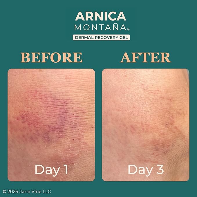 Arnica Gel For Face, Arnica Cream and Bruise Cream to Soothe with Aloe and Calendula for Face and Body, Menthol Free, Alcohol Free, 7oz Pump