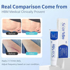 HBM Medical Grade Silicone Scar Gel, Advanced Scar Removal Cream for Old & New Scars, Stretch Marks, Surgical Scars, Keloids, Acne, C-Section & Burn Scars, 30g