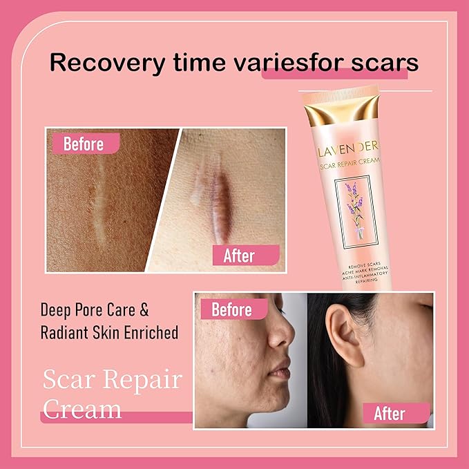 Lavender Scar Repair Cream for surgical scars, burns, acne, C-sections, stretch marks, keloids, and scar removal. Suitable for men and women. 1.7 oz. (1)