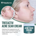 TreeActiv Acne Scar Cream, 2 fl oz, Scar Cream for Face and Dark Spot Remover, Lotion for Stretch Marks and Body, Acne Scar Removal for All Skin Types, 500+ Uses