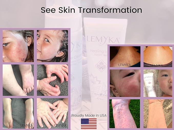 Rosacea cream -face redness relief facial rash lotion for eczema, psoriasis, hives, and dry skin, LEMYKA natural healing for babies and adults